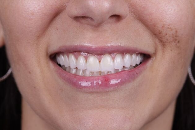 Smile Transformations Case 4 - After
