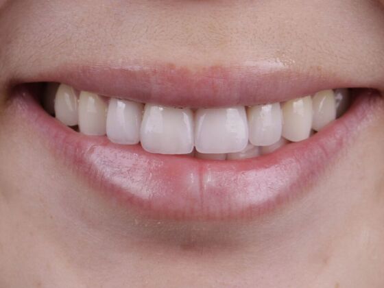 Smile Transformations Case 6 - After