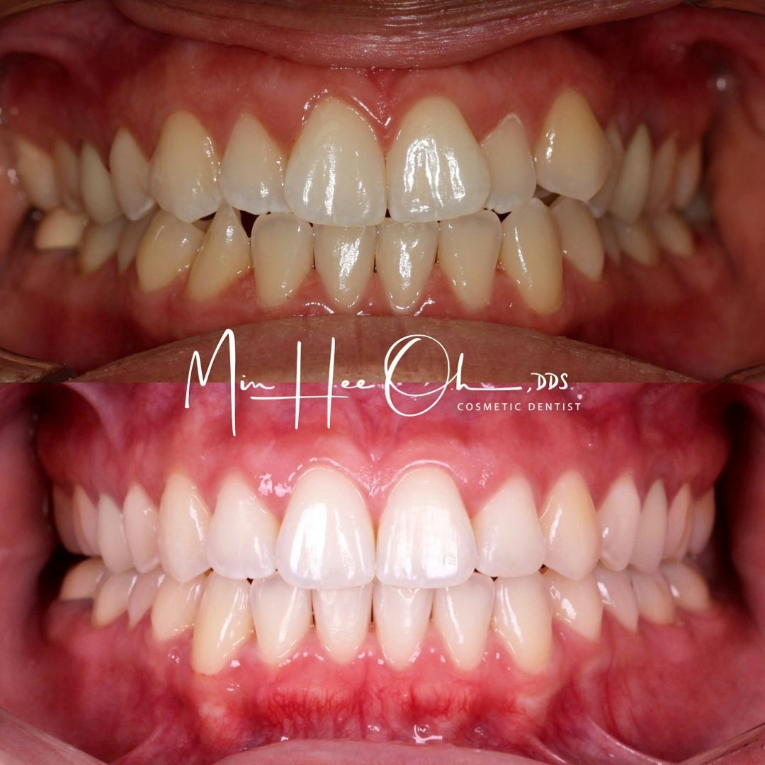 Dr. Oh's patient before and after Invisalign