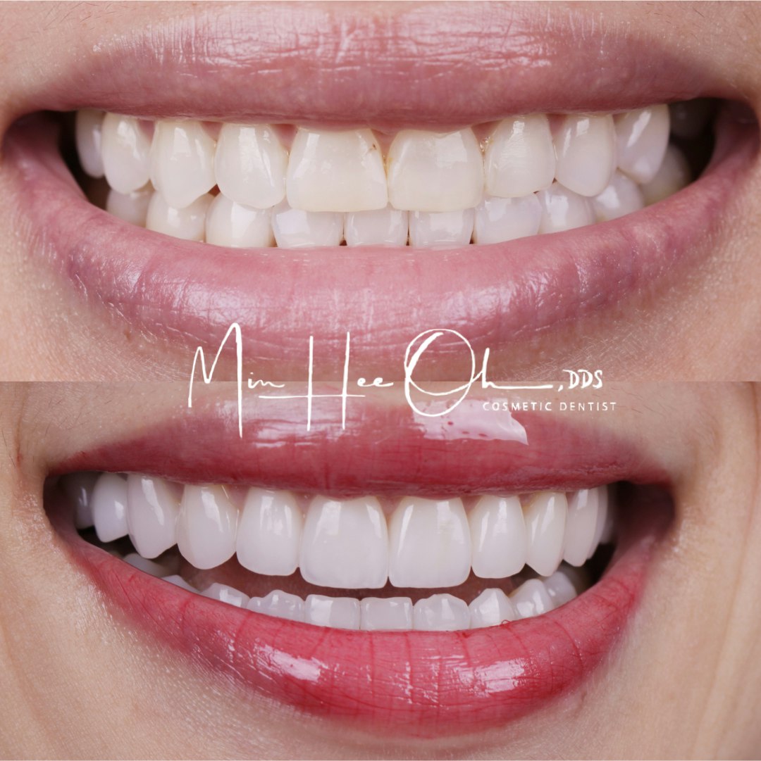 Dr. Oh's patient before and after veneers