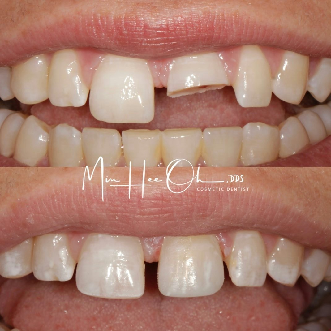 broken front tooth