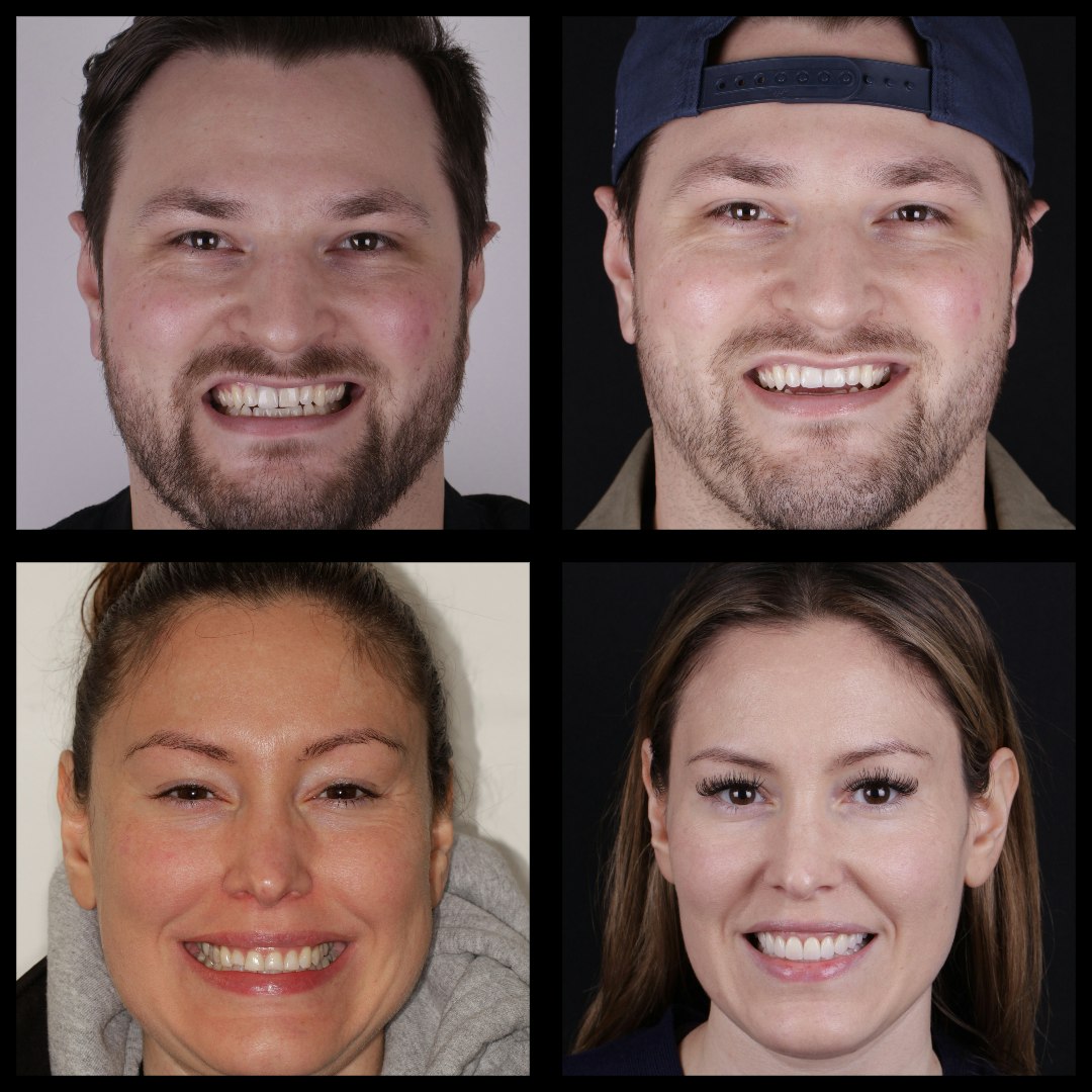 two veneer patients before and after treatment