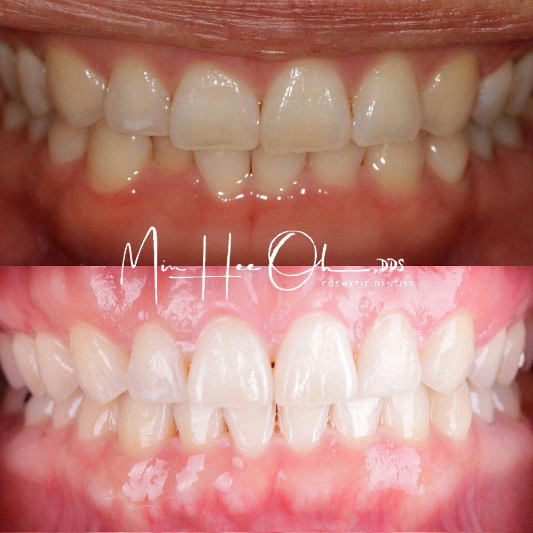 LA patient before and after teeth whitening